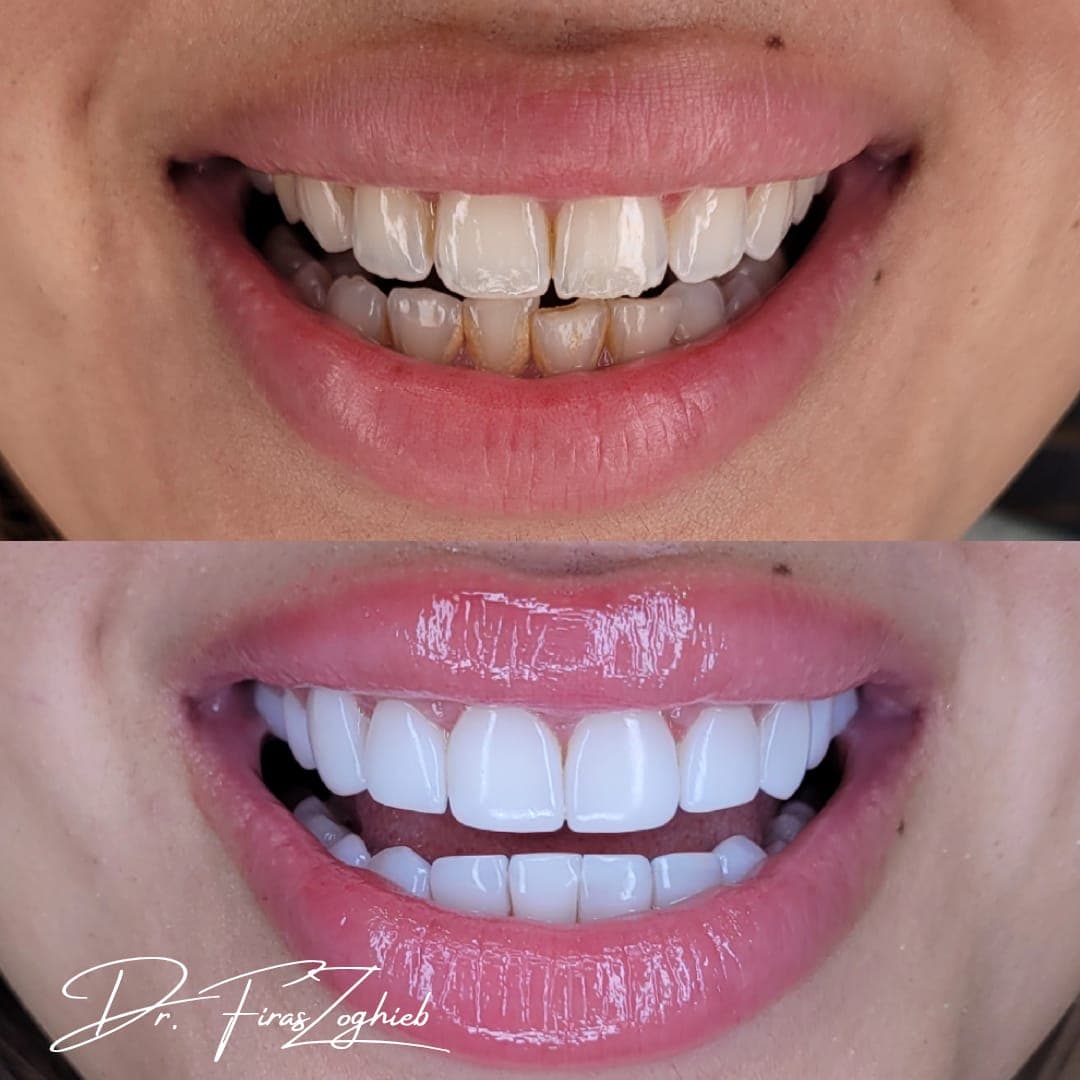 No-Prep Veneers in Dubai: A Conservative Way to Enhance Your Smile