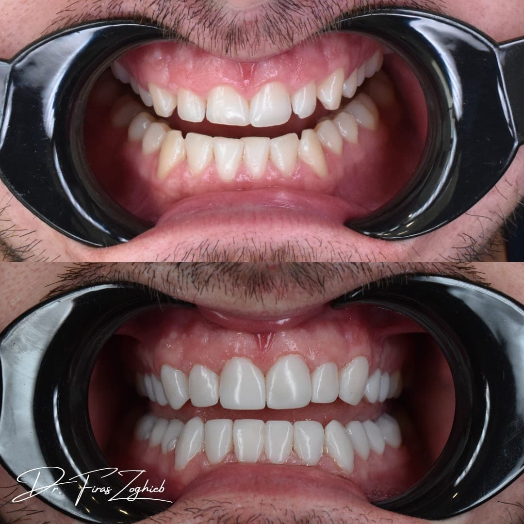 Veneers Near Al Wasl Road Dubai: What to Know Before Booking