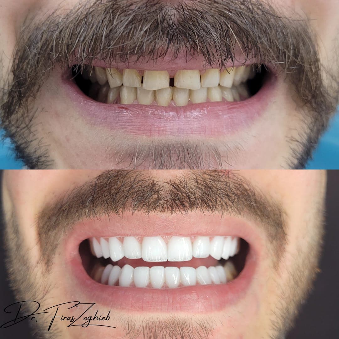 Is Composite Bonding Painful? What Patients Should Know