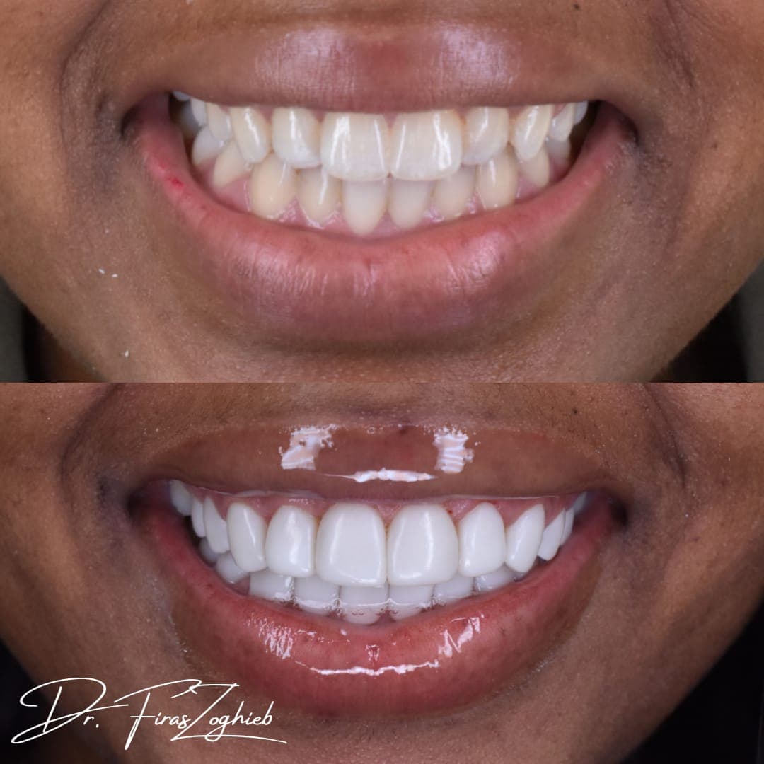 How to Maintain Composite Bonding After Treatment
