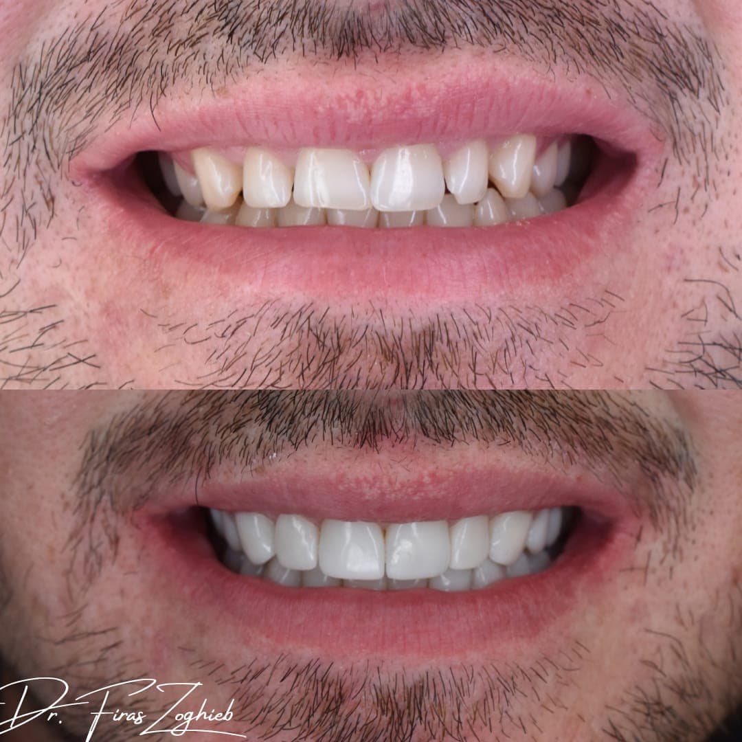 Composite Bonding for Small Teeth in Dubai
