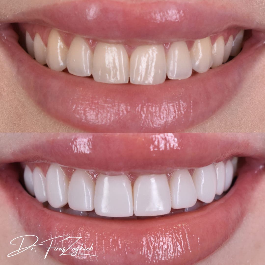Is Composite Bonding Worth It in Dubai? What Patients Should Know