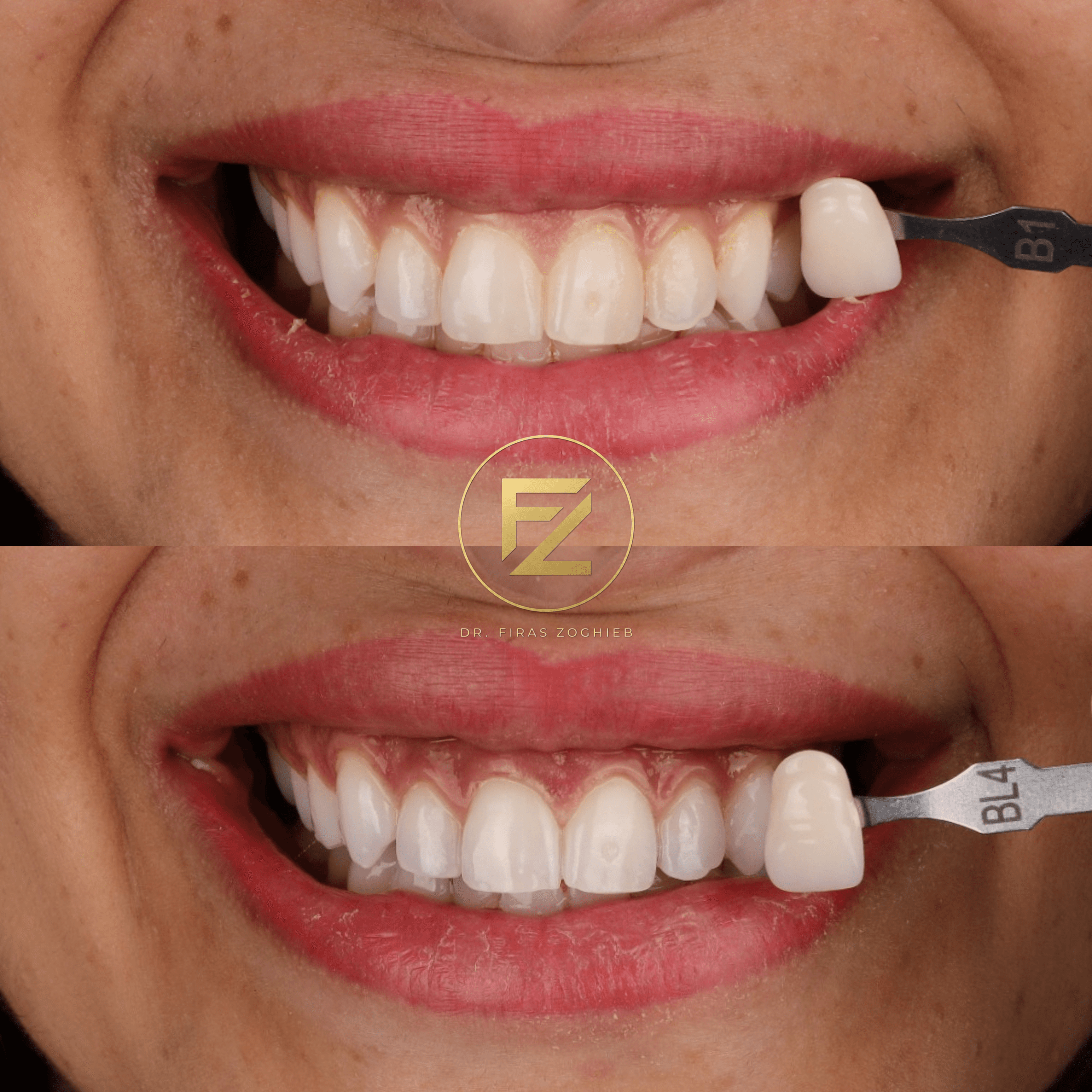 Teeth Whitening